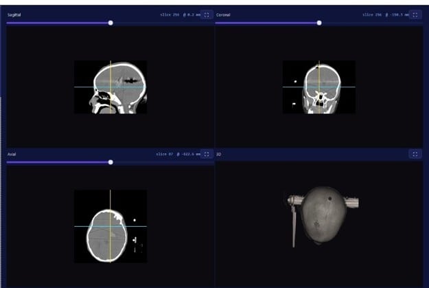 NeuroTech A1 Surgical Planning software interface